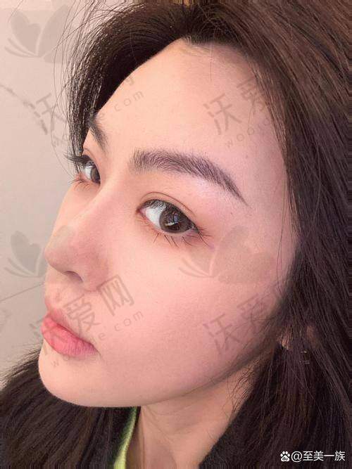 上海首尔丽格瑞蓝丽瑅玻尿酸隆鼻8800元起1mL推荐周福田医生，多技术打造自然美鼻超安心