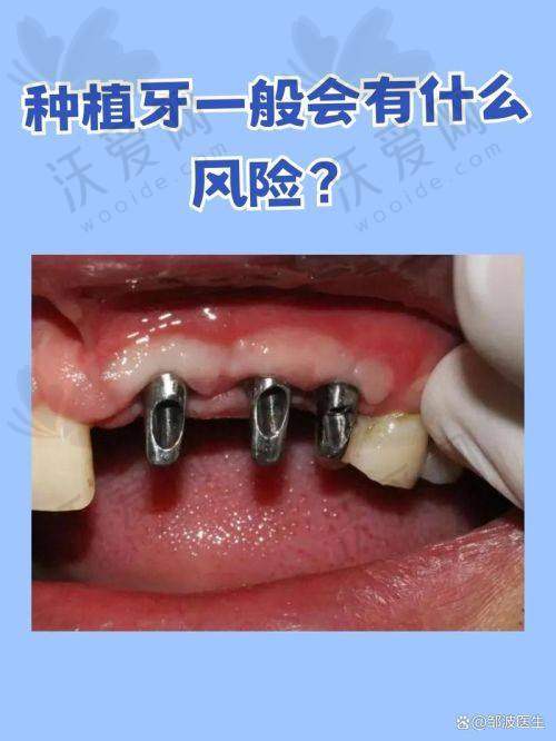 苏州美奥口腔瑞典诺贝尔CC种植牙的出色技术水平