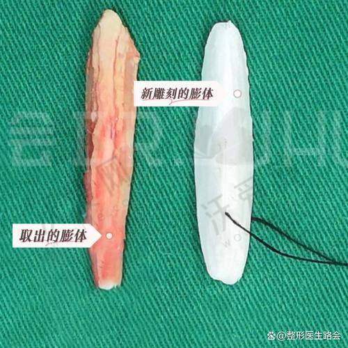 上海首尔丽格美国进口射极峰膨体隆鼻1.38万起可预约任钟赫，优质材料+微创技术打造自然美鼻