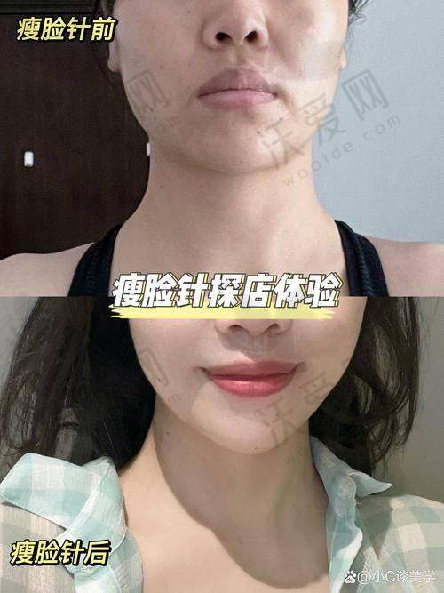上海首尔丽格韩莉亚韩国瘦脸针1589元起100单位，韩医生审美加持打造自然精致脸型