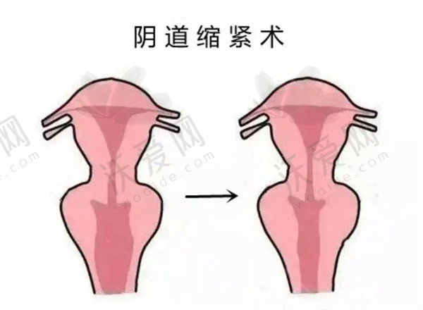 深圳阳光整形传统手术紧缩阴道原价8000元，现3800元起快享成熟技术实惠价格！