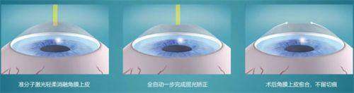 总结——济南普瑞眼科医院张泳医生怎么样？