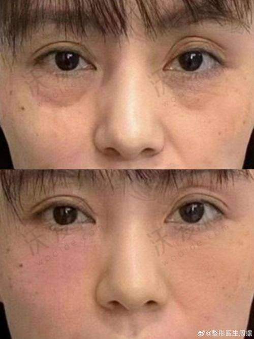 上海首尔丽格任钟赫医生做外入眼袋平衡术1.28万起，个性化方案打造自然有神美眼