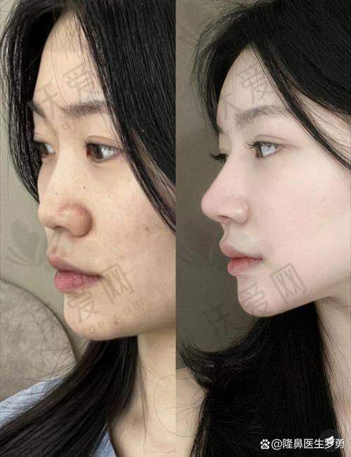 上海首尔丽格耳软骨硅胶隆鼻用的什么材料？
