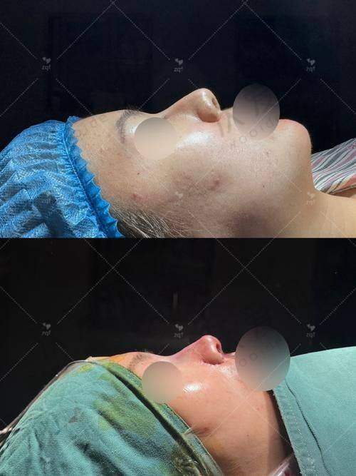 上海首尔丽格整形美容医院立秀膨体隆鼻6800元起，个性化美鼻方案开启精致蜕变之旅