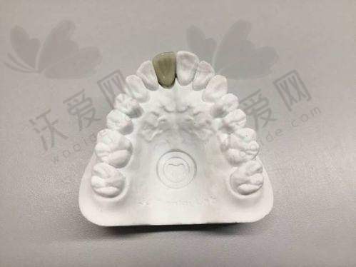 宁波牙博士口腔烤瓷牙技术有哪些优势？