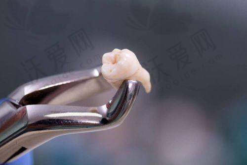 南通美奥口腔医院松动牙拔除的精良技术