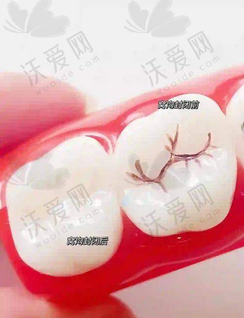 南通美奥口腔医院儿童窝沟封闭的技术优势