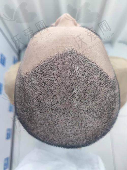 常州百年植发医疗美容诊所技术好不好？