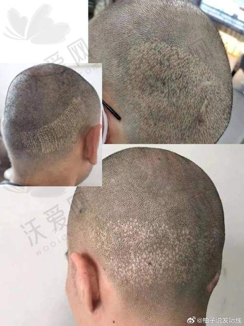 苏州百年植发医院地址
