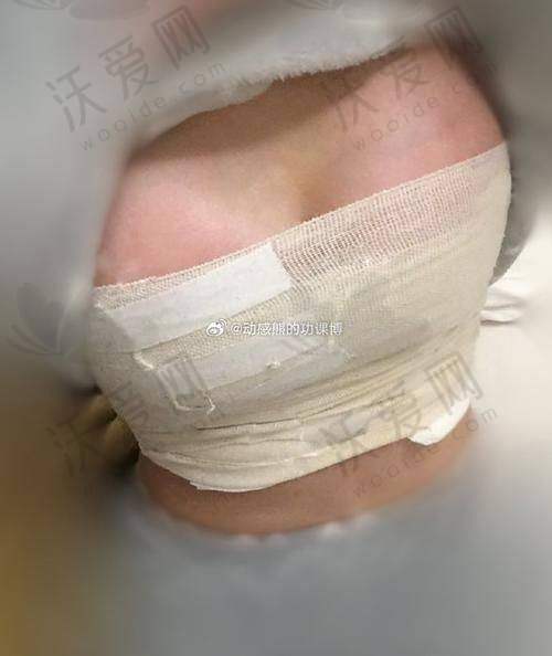 上海首尔丽格美国MOTIVA·梦萦假体隆胸15.8W起唐鏖医生技术值，多种型号+硬核实力打造自然美胸