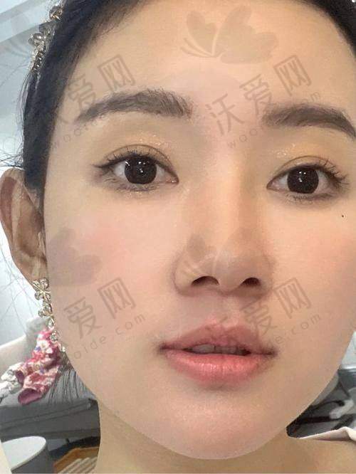 深圳阳光整形薇旖美胶原蛋白4mg的作用成效