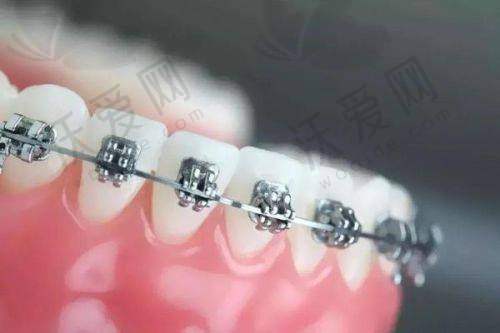 福清华南口腔——牙齿矫正技术成熟