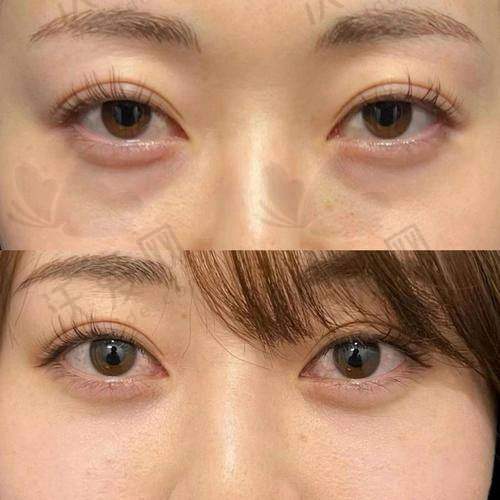 南宁健丽医美去眼袋费用及价格详情