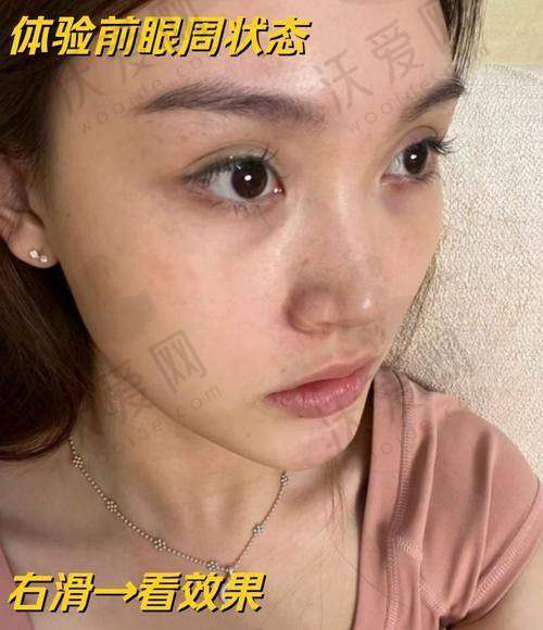 上海首尔丽格嗨体1.0mL淡化黑眼圈1580元起，精准定制滋养眼肌焕亮双眸告别熊猫眼