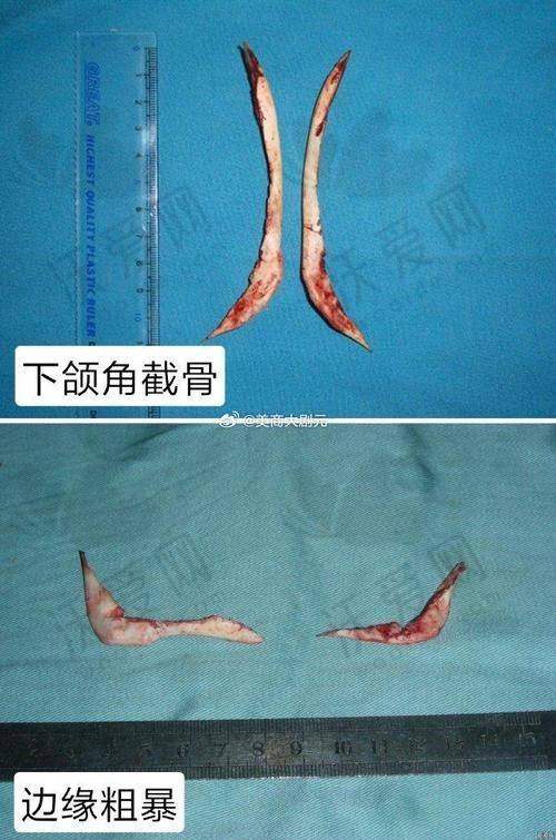 北京联合丽格第一医院何照华医生磨骨技术怎么样？