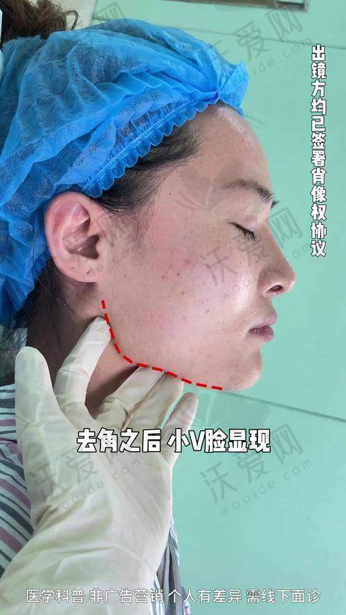北京联合丽格第一医院何照华医生颧骨内推手术有什么优势？