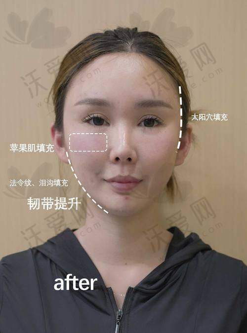 重庆星荣整形樊雯君医生脂肪胶填充太阳穴9800元起显著提升外轮廓，成活率高还能改善肤质！