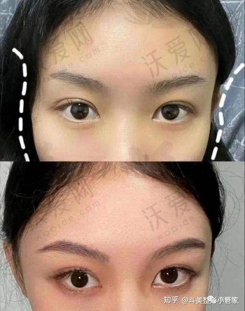 重庆星荣整形脂肪胶填充太阳穴技术有哪些优势？