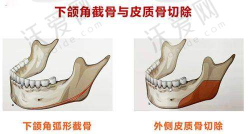 上海首尔丽格乔雅登极致玻尿酸0.8mL外轮廓塑形适合哪些人？