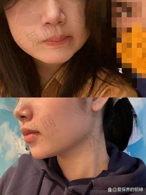 重庆星荣整形美国瘦脸100单位+下颌缘提升价格2980元起推荐樊雯君医生，助你轻松拥有精致轮廓