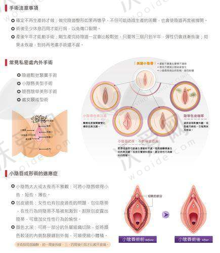 郑州张红歌医生私密整形预约攻略来了！还有张红歌做阴道紧缩术优势、价格探索