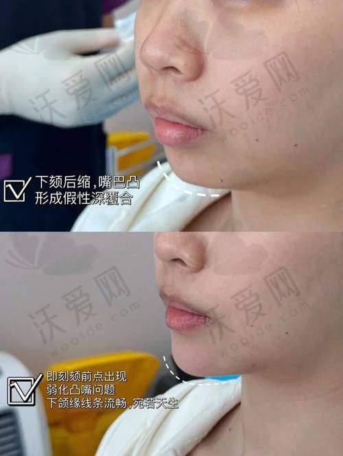 上海首尔丽格乔雅登极致玻尿酸0.8mL外轮廓塑形使用的产品如何？