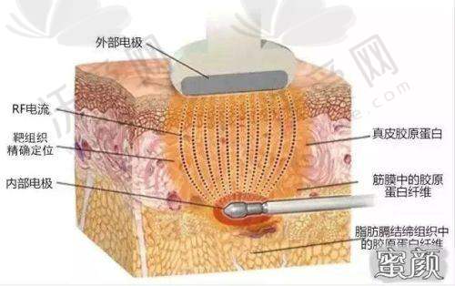 上海首尔丽格下颌缘inmode超塑射频紧肤880元起，缩脂紧肤双效，国内享韩系美肤体验