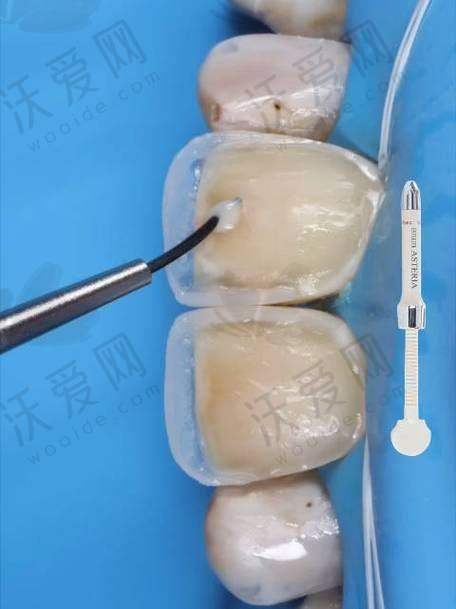 苏州美奥口腔原价1350元树脂补牙美学修复现780元起，五维方案焕新美牙体验！