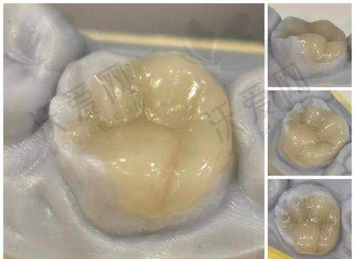 苏州美奥口腔树脂补牙美学修复的五维优化方案
