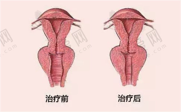 阴道紧缩针价格及维持时间大揭秘！多因素影响费用和效果，选对机构很重要