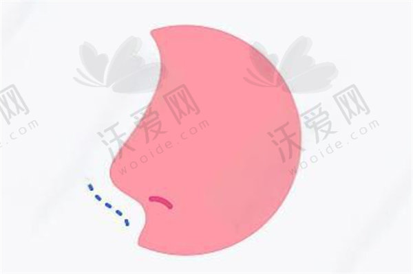 杭州浮想国医美蒋铮铮打乔雅登缇颜玻尿酸注射隆鼻价格15888元起，塑形持久安全还兼顾面部美学！