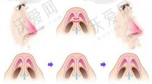 北京画美医疗美容医院吴磊医生技术好不好？