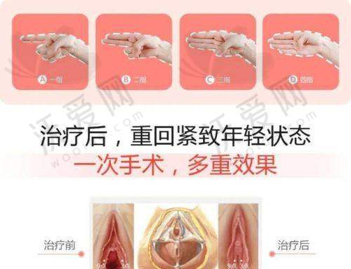 阴道紧缩针的结果持续时间