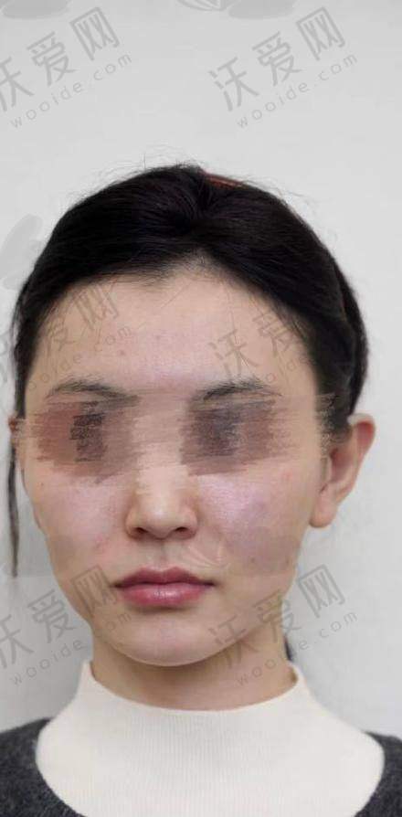 重庆星荣整形外科医院中下面部埋线提升技术优势显著