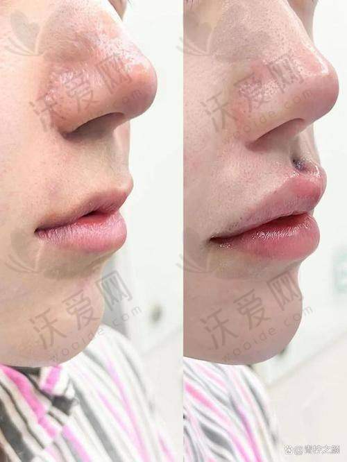 总结——北京画美医疗美容医院马群医生怎么样？