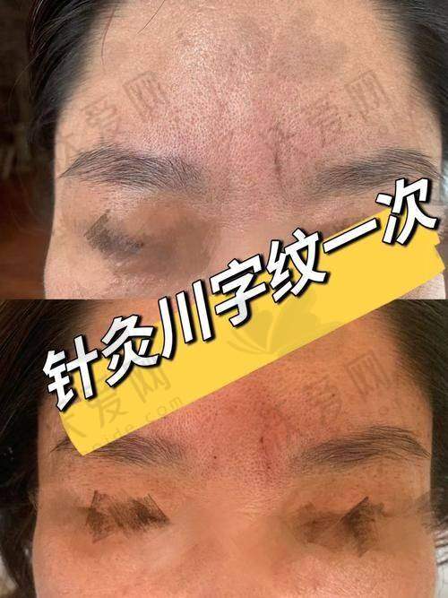 杭州浮想国医疗美容川字纹除皱针国产品牌有什么原理和优势？
