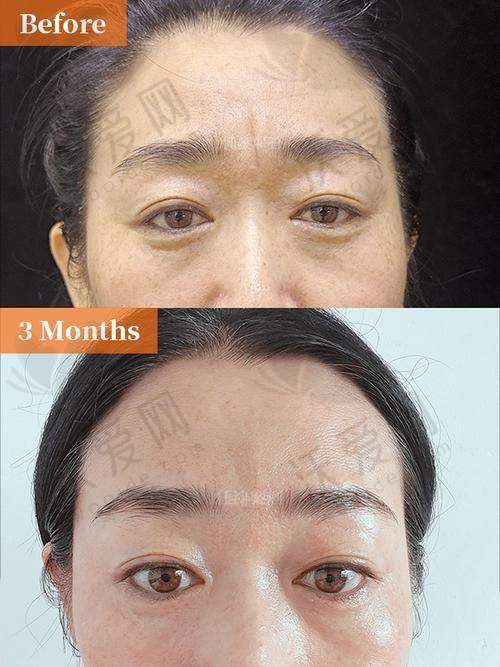杭州浮想国医美杭州浮想国医疗美容川字纹除皱针国产品牌499元起，低风险快恢复还能个性定制！