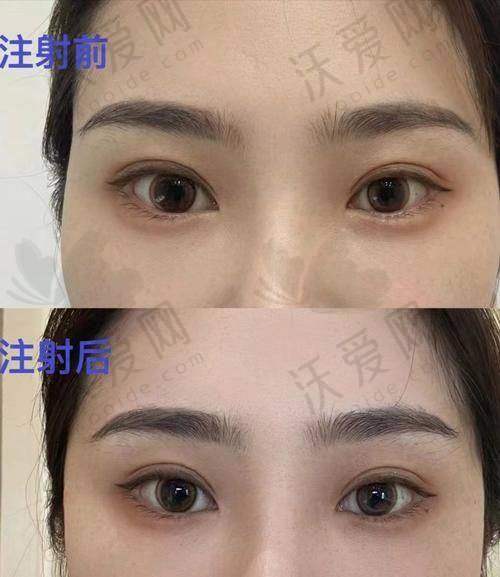 杭州浮想国医美莫娜丽莎玻尿酸外轮廓提升的作用与成效