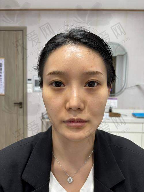 杭州浮想国医美莫娜丽莎玻尿酸外轮廓提升的价格与优惠