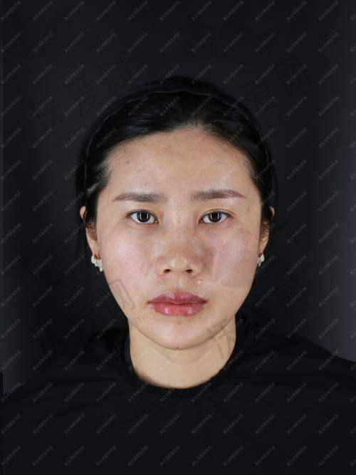 杭州浮想国医美莫娜丽莎玻尿酸外轮廓提升的技术优势