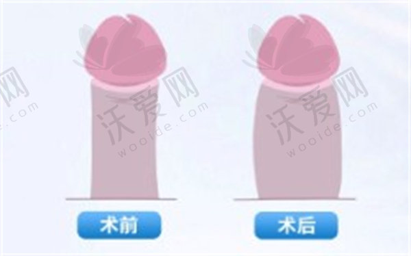 重庆星荣整形外科医院男性私密脂肪胶增粗原价3.6万现2.8万起，脂肪存活率80%维持5年！