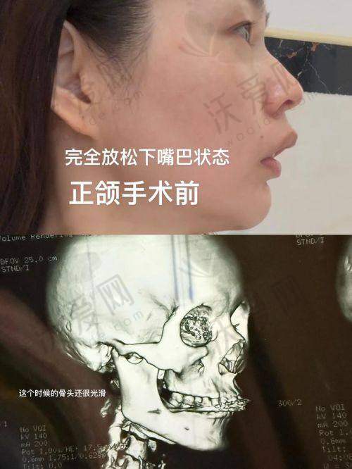 广州广大整形医院薛国初医生技术好不好？