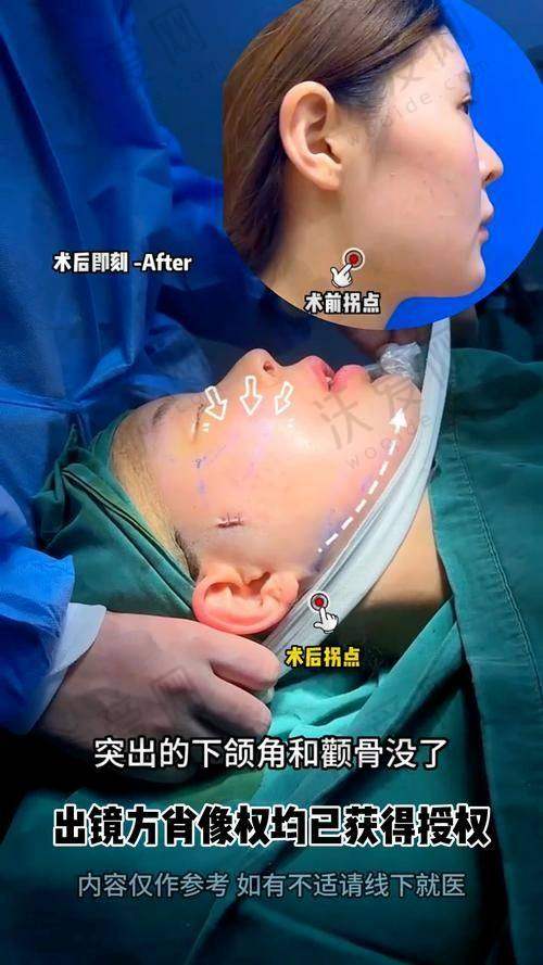总结——广州广大整形医院徐威强医生怎么样？
