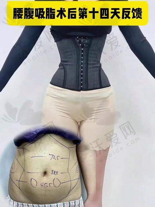 宁波海曙熙美医疗美容门诊部（吸脂专科）技术好不好？