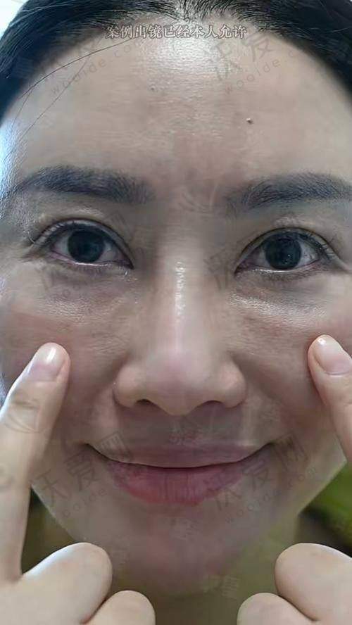 广州荔湾清奥中心取异物价格1万起，正规靠谱技术优，周云超医生也超厉害