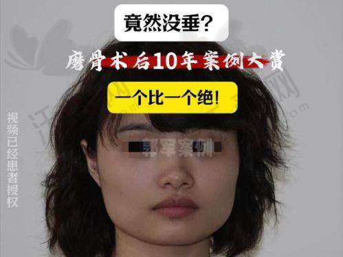 总结——广州广大整形医院朴正国医生怎么样？