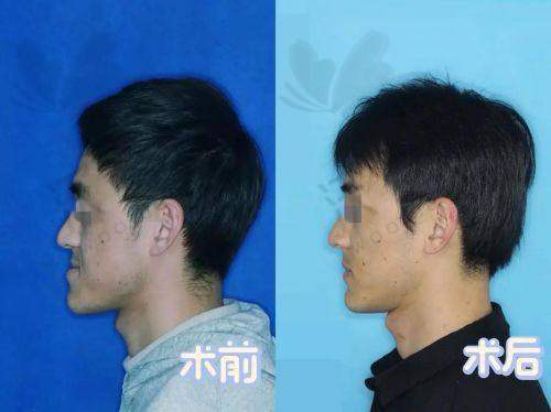 广州广大整形医院艾伟健医生口碑评价如何？