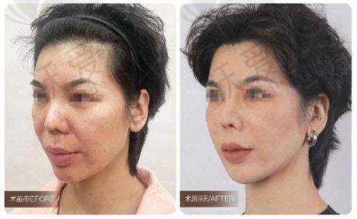 韩国优雅人整形外科医院——鼻部整形实力派