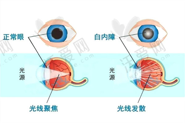 丽水华厦眼科白内障单焦人工晶体植入4880元起，技术优恢复快还享医保福利